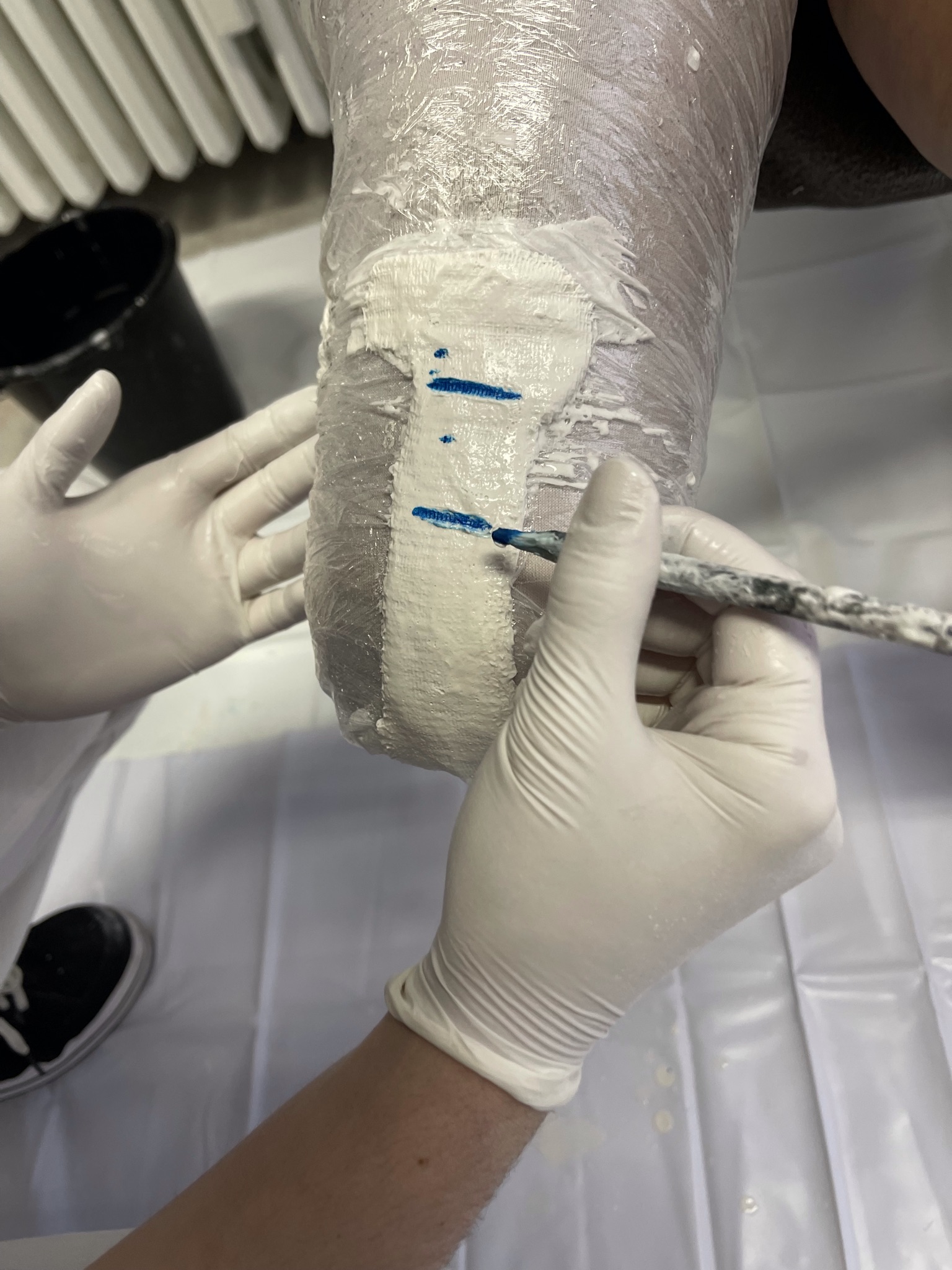 Markierung eines Gipsabdrucks am Oberschenkelstumpf zur Vorbereitung einer individuellen Prothesenanpassung