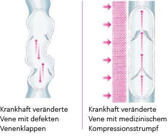 Grafik Wirkung Kompressionsstrumpf